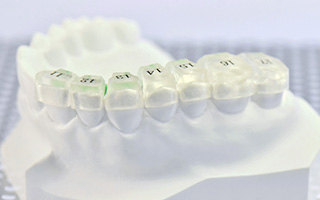 リボンディングに使用可能な個歯タイプのインダイレクトボンディングコア
